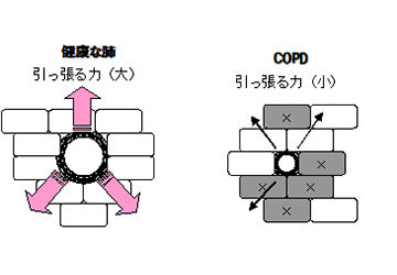 肺気腫