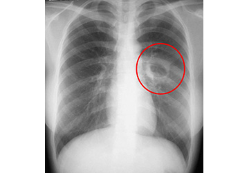 レントゲン 影 肺 白い