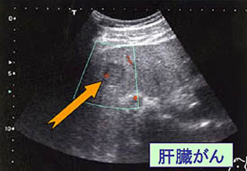 腹部エコー