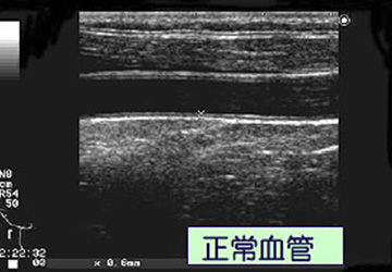 頸動脈エコー