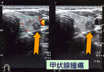 甲状腺エコー