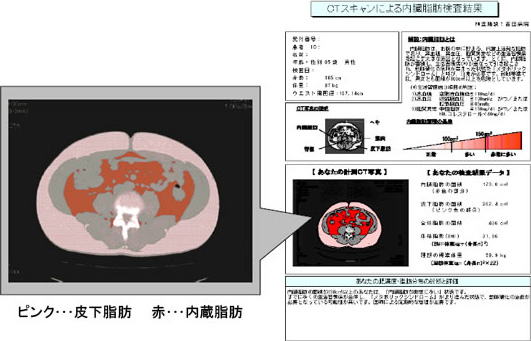 CTスキャンによる内臓脂肪検査結果